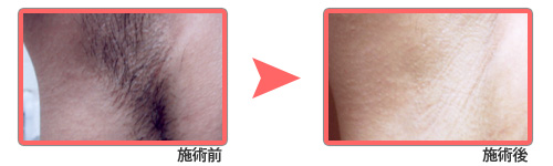 レーザー脱毛施術例