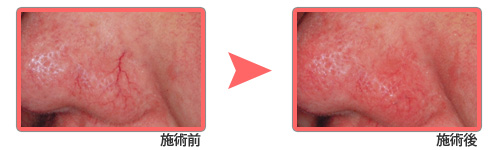 毛細血管拡張症